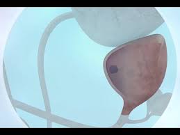 In its early stages, prostate cancer may not have any symptoms. What Are The Signs And Symptoms Of Prostate Cancer Cancer Research Uk Youtube