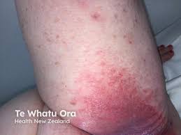 Image result for Intertrigo under breasts