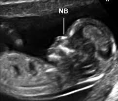 What does the conception + 2 weeks mean? Https Www Isuog Org Uploads Assets Uploaded 4daa1ea7 Bc64 4c24 B81b17df5a684a38 Pdf