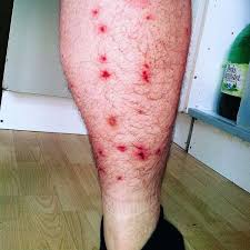 Image result for bedbugs bites