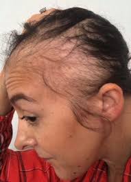 Has any other moms had hair loss after they had a baby? I Lost All My Hair After Having A Baby And It Never Grew Back People Think I Have Cancer