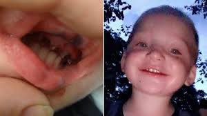 Boy, 1, left with razor-sharp fangs after painful root canal surgery went  wrong