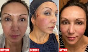 Check spelling or type a new query. Could A One Hour Facelift Knock Years Off Your Appearance Daily Mail Online