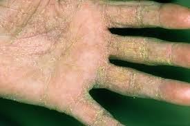 Image result for scabies human bites