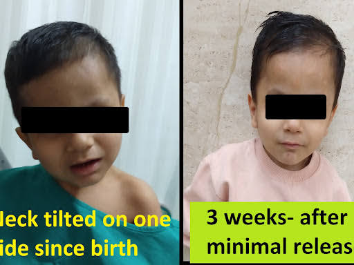 Congenital Torticollis Correction product image
