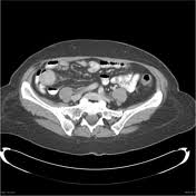 Carcinoid tumors may form in other organs of the body besides the lungs. Carcinoid Tumor Radiology Reference Article Radiopaedia Org