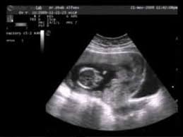 4 dimensi hamil 3 bulan usg 11 minggu janin 9 minggu dalam kandungan 12 minggu kehamilan perkembangan janin 3 bulan. Bentuk Bayi 3 Bulan Dalam Kandungan Berbagi Bentuk Penting