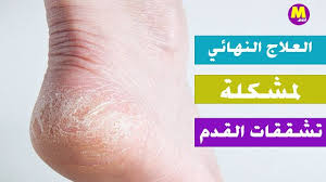 موضوعات دوت نت تخلصي من مشكلة تشقق القدمين بهذه الطرق المجربة Home Remedies Remedies How To Get Rid
