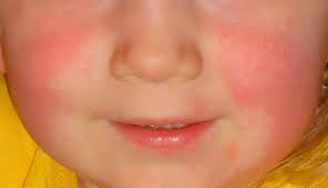 Image result for Scarlet Fever