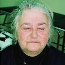 Ce sont des prédateurs , de. Differential Diagnoses Of Morbihan Syndrome Download Scientific Diagram