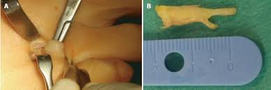 Brief information on the history of the issue is given. Role Of Imaging Methods In Diagnosis And Treatment Of Morton S Neuroma