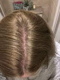 Buy dianette quickly and safely online at euroclinix.net. My Hair Mumsnet
