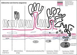 The signs and symptoms of cancer recurrence; Colon Cancer Intechopen