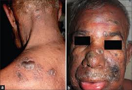 Image result for Varicella zoster on human skin