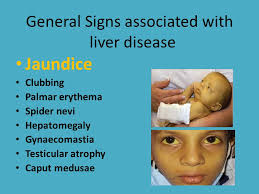 Liver Disease In Babies