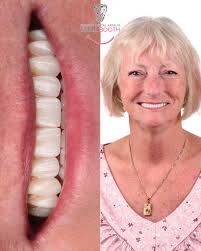 Febe's Smile Transformation ✨ When Febe first visited our clinic, she had  been edentulous for more than 10 years and was relying