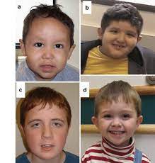 Folds also occur in certain congenital conditions, including fetal alcohol syndrome. A Patient 1 Facial Features Including High Anterior Hair Line Broad Download Scientific Diagram