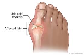 The left foot big toes with gout. Gouty Big Toe