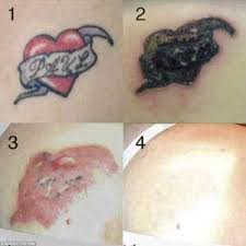 Home tattoo removal (under $10): Tattoo Removal Options And Potential Side Effects Tattooli Com