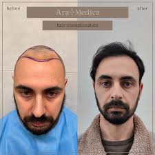 Transplantace vlasů v Turecku: ptali jsme se na vaše zkušenosti
