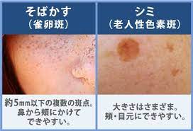 シミ そばかす そばかす シミ 皮膚科