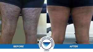 Women's laser hair removal prices are shown below. Laser Hair Removal For Men