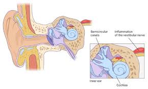 Image result for Acute Labyrinthitis