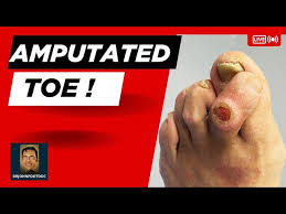 Image result for toe amputation
