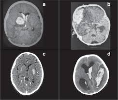 Cva is an adjustment to the fair value (or price) of derivative instruments to account for counterparty thus, cva is commonly viewed as the price of ccr. High Incidence Of Stroke And Mortality In Pediatric Critical Care Patients With Covid 19 In Peru Pediatric Research