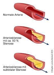 Angina Pectoris Deximed