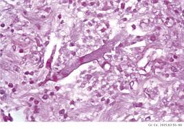 Los la angioinvasión asociada con la mucormicosis previene la administración eficaz del fármaco al enfermo. Emphysematous Gastritis Secondary To Gastric Mucormycosis Cirugia Y Cirujanos English Edition