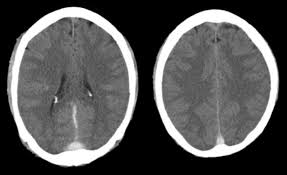 Common subtypes include transverse sinus thrombosis and superior sagittal sinus. Sagittal Sinuscase 201