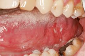 Was hat der arzt gegen die tonsillaris verordnet? Die Zunge Normvarianten Und Pathologische Veranderungen Quintessenz Verlags Gmbh