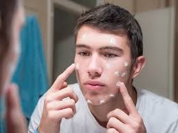 The tea tree plant is native to the australian continent, and has been used in folk medicine, to treat skin conditions. How To And Not To Treat A Pimple Insider