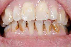 Get the bright smile you've always wanted with our teeth whitening system! Types Of Tooth Stains And Their Treatment Methods Mia Online