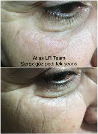Serox Goz Pedi Tek Seans Uygulama Gozler