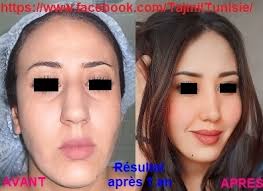 ‫جراحة التجميل في تونس الصدر البطن الأنف الوجه الشعر شفط الدهون | Tunis‬‎