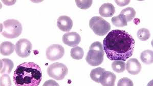 Leukemia is a type of blood cancer that affects your bone marrow, which makes blood. Las Celulas De La Leucemia Corren Para Sobrevivir A Los Farmacos