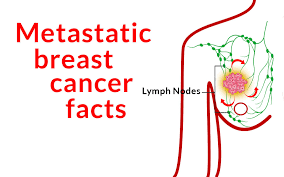 Breast cancer is treated in several ways. How To Control Metastatic Breast Cancer Dr Zembroski