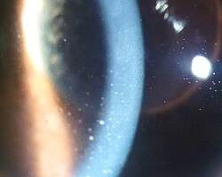 uveitis eye inflammation photo wikipedia, AI generated