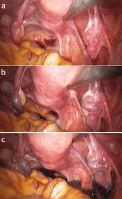 This article reviews the basic tenets of gynecologic laparoscopy: Technique Of Single Incision Laparoscopy And Chromopertubation First Download Scientific Diagram