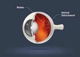 The retina is the thin layer of tissue at the back of the eye that is essential for proper vision. The Top Signs You Have Retinal Detachment Drs Campbell Cunningham Taylor And Haun