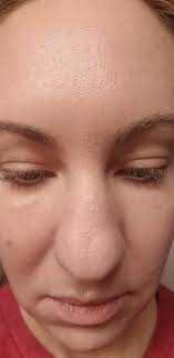 I Tried It: The Photofractional Facial