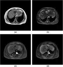 26.11.2021 · the mission of clinical imaging is to publish innovative radiology research, reviews & editorials which advance knowledge and positively impact patient care and the profession of radiology. Ct And Mri Studies Of Hepatic Angiosarcoma Clinical Radiology