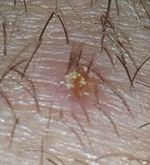 Ingrown hair is a common problem faced by ladies who frequently wax or shave their bodies. Infected Ingrown Hairs Or Herpes Sexual Health Forums Patient