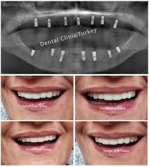 Patients tend to get this denture reline option more than the other relining due to how comfortable it is. Full Mouth Dental Implants Dental Clinic Turkey