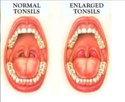 9 Natural Remedies For Tonsillitis Swollen Tonsils Remedies For Swollen Tonsils Swollen Tonsils Tonsilitis Remedy