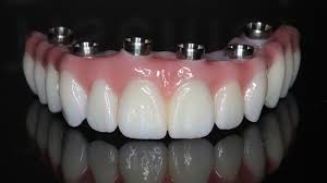 Implantes Dentários, Implantes Dentários Zona Sul, Implantes Dentários na Zona Sul, Implantes Dentários Zona Sul SP, Implantes Dentários na Zona Sul SP, Implantes Dentários Zona Sul de SP, Implantes Dentários na Zona Sul de SP, Implantes Dentários Zona Sul de São Paulo, Implantes Dentários na Zona Sul de São Paulo, Implantes Dentários SP, Implantes Dentários em SP, Implantes Dentários São Paulo, Implantes Dentários em São Paulo,