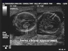 Ultrasound Of Choroid Plexus Cysts