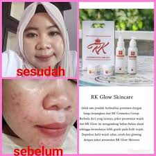 Check spelling or type a new query. Rk Glow Premium Cream Rk Cream Jerawat Cream Glowing Rk Glow Lazada Indonesia